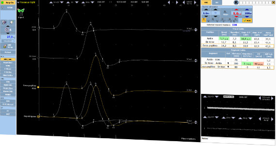 Software TruTrace Fascia: conducción nerviosa