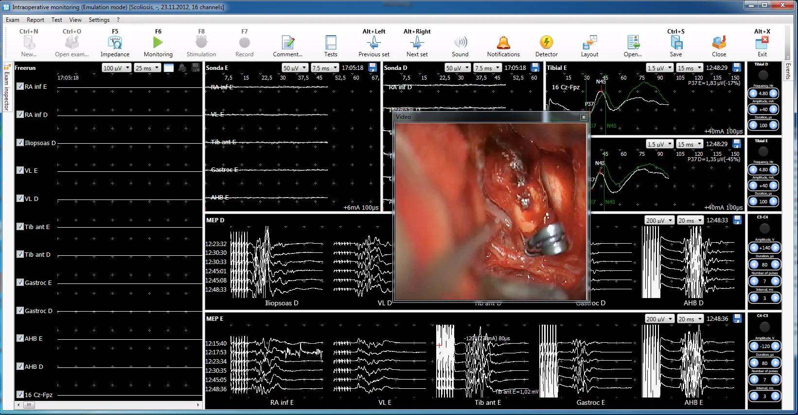 Modalidades Neuro-IOM